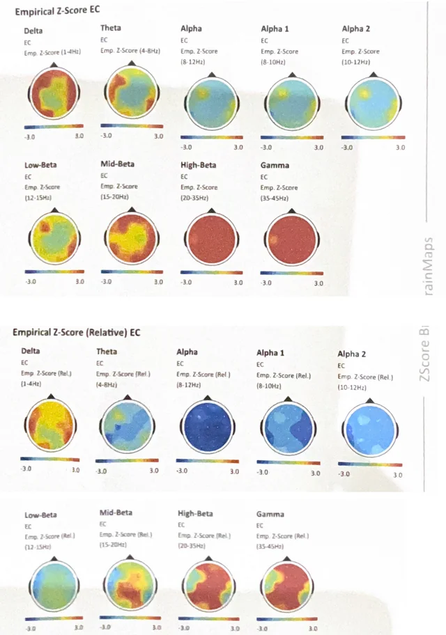 figure-2-eeg